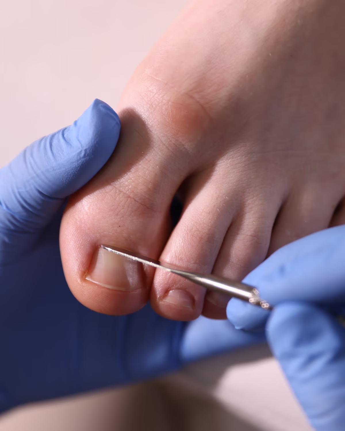 Ingrown Toenail — The Foot Lab podiatry clinic, Glossop, North West