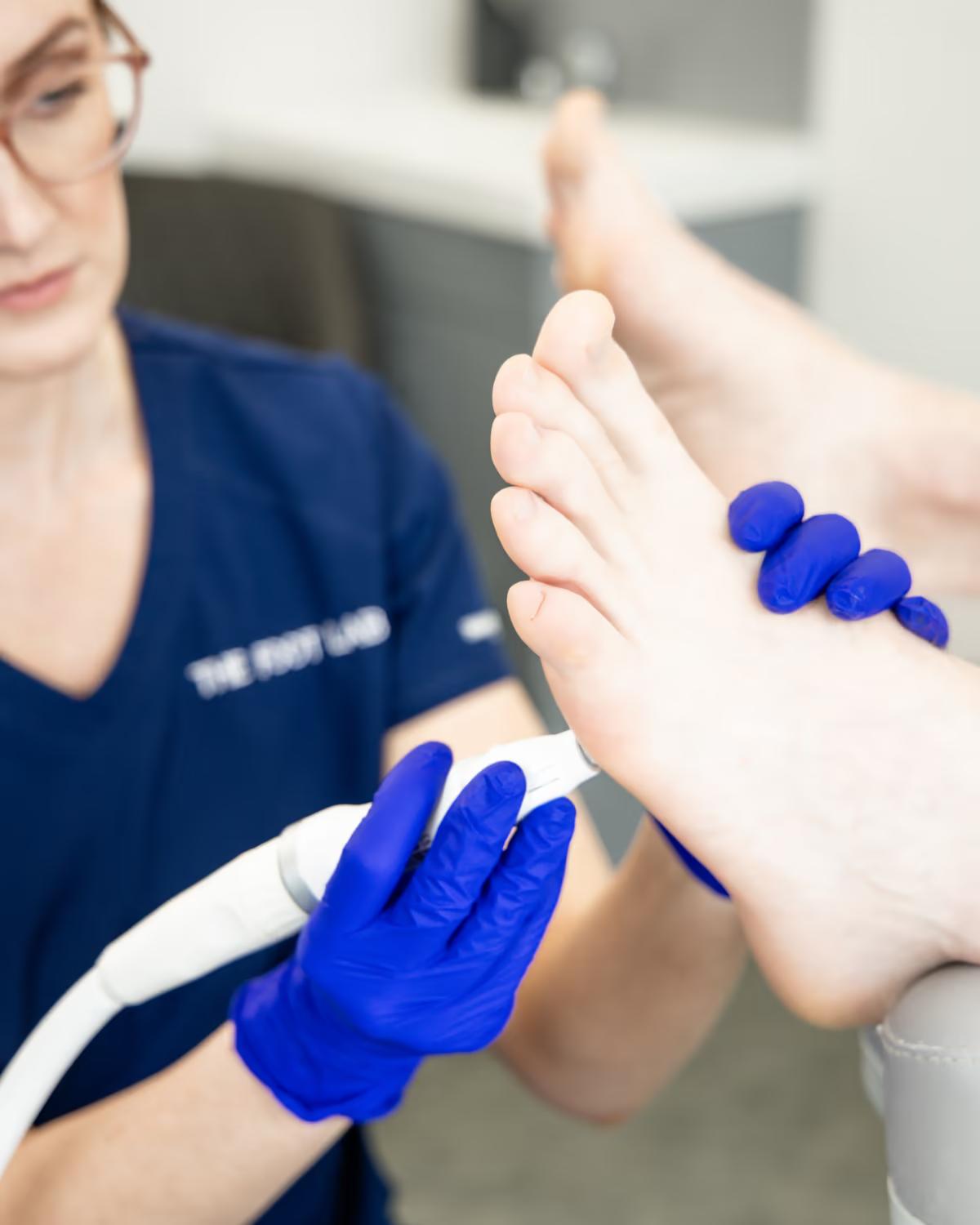 Verrucas & Warts — The Foot Lab podiatry clinic, Glossop, North West