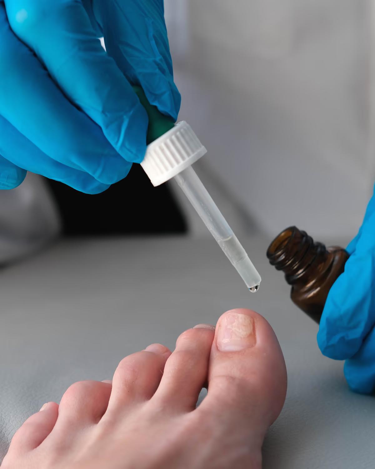 Fungal Nails — The Foot Lab podiatry clinic, Glossop, North West