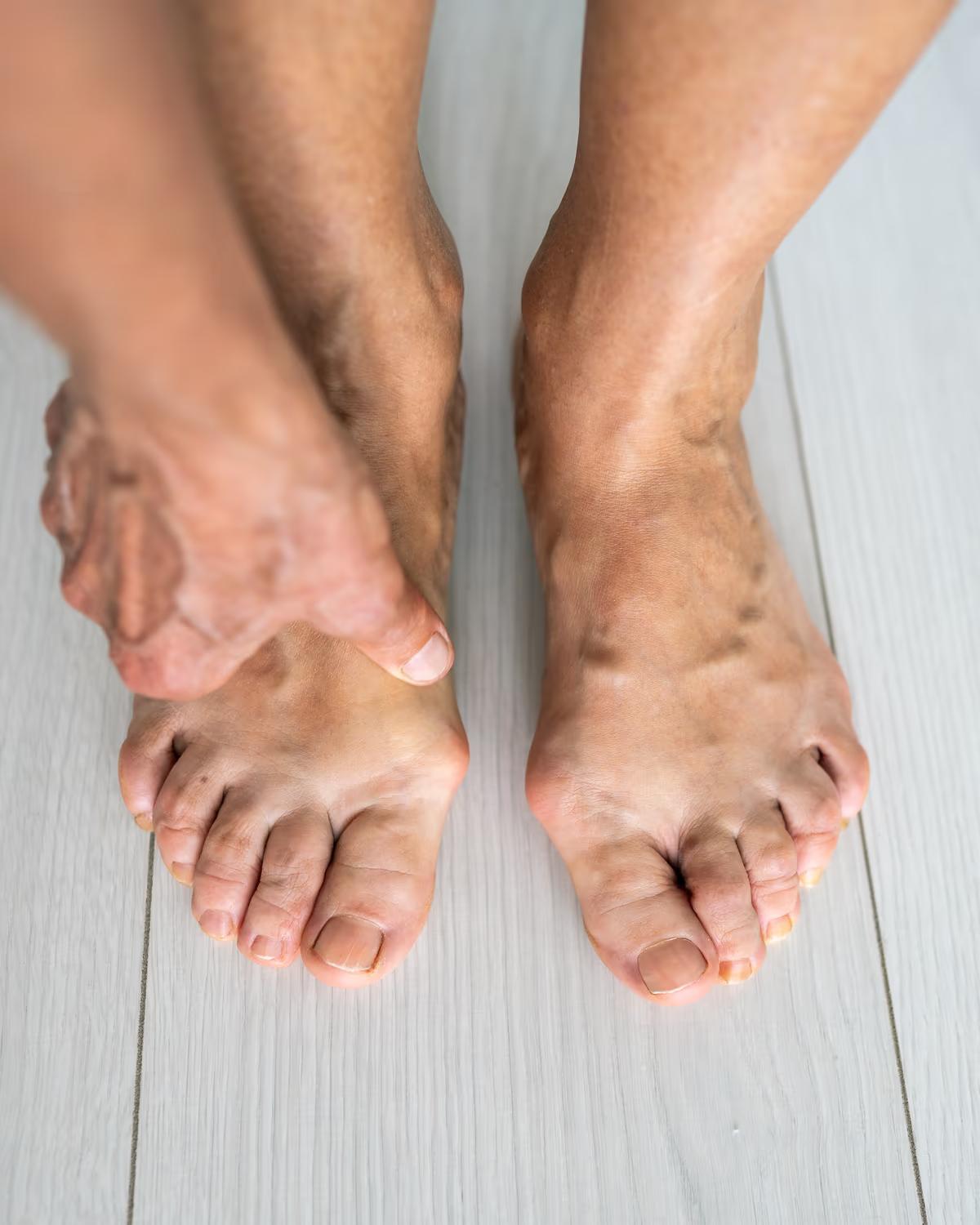 Bunions — The Foot Lab podiatry clinic, Glossop, North West