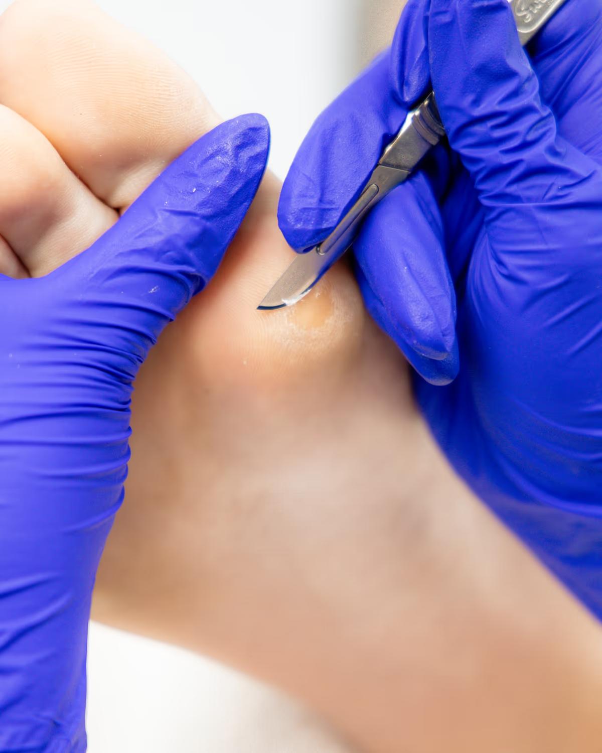 Corns & Callus — The Foot Lab podiatry clinic, Glossop, North West