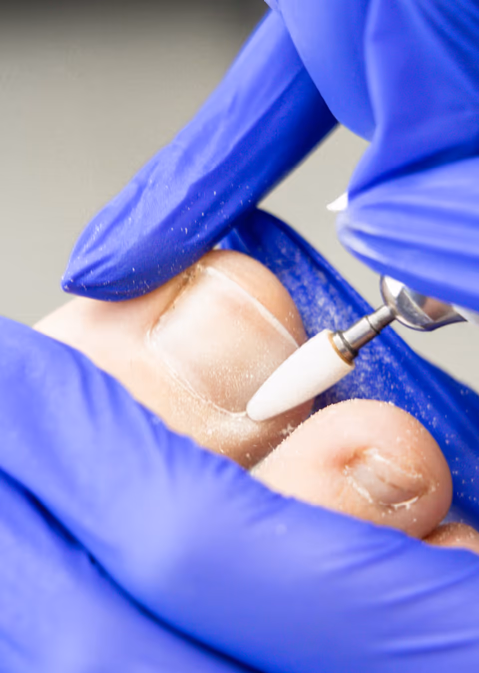 Ingrown Toenail Appointments — The Foot Lab podiatry clinic, Glossop, North West