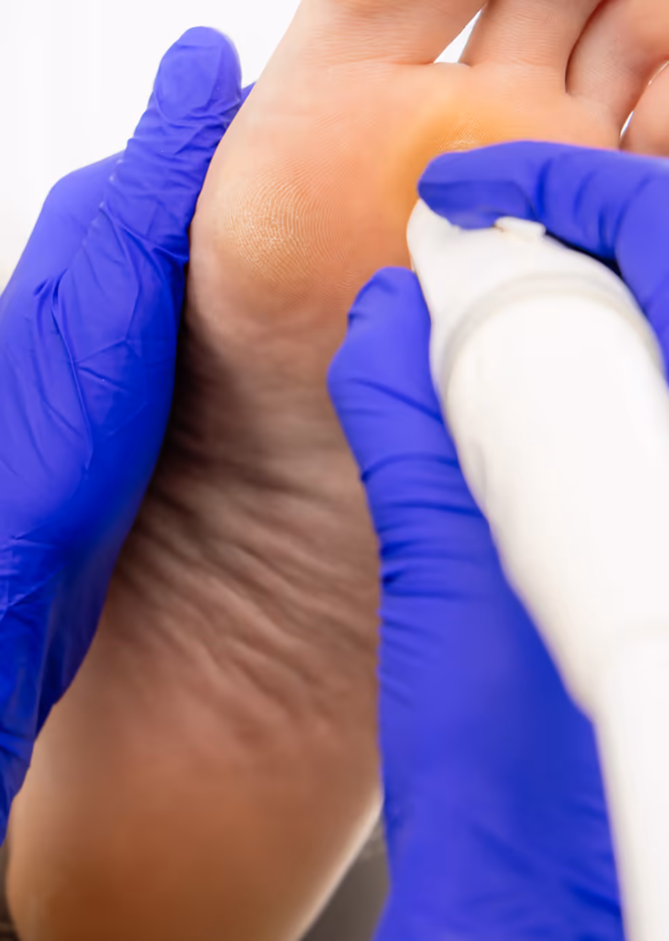 Verrucas & Warts — The Foot Lab podiatry clinic, Glossop, North West